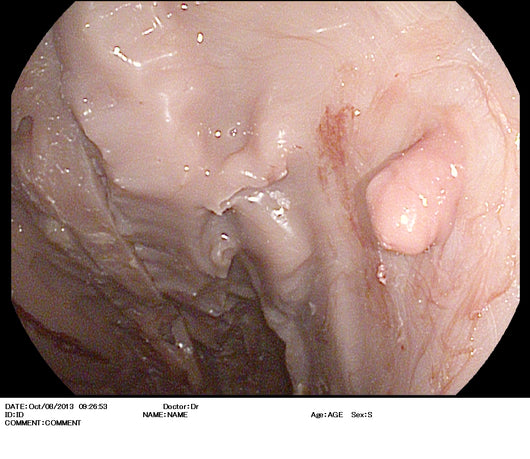 RENTAL of SYNTHETIC MODEL - Upper GI Model with gastric disease states