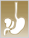 EXPLANT - BIL Stones = Biliary with 4 stones