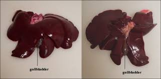 EXPLANT - Biliary with full billy tree